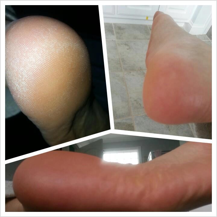 Aloette Enzyme Peel Before and After